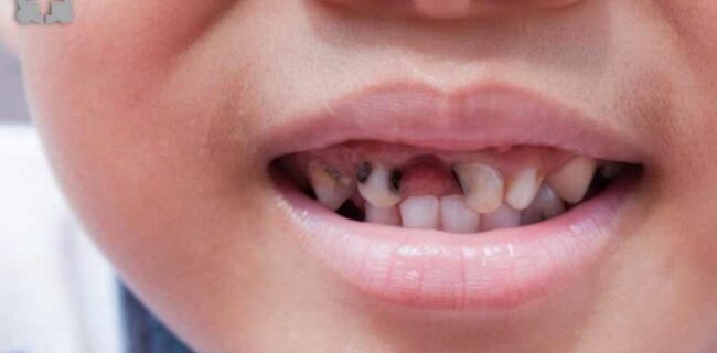 ۲۵۰‌میلیون دندان فاسد در ایران